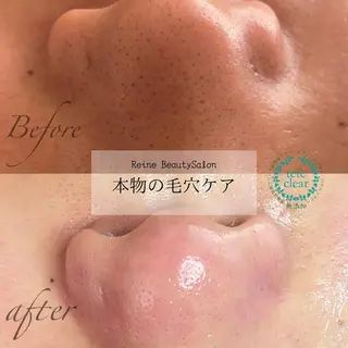 毛穴/シミ肝斑/脱毛 横山梨里のエステ・リラクイメージ