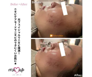 Meupニキビ専門店 背中/ハーブ/肌管理のその他イメージ