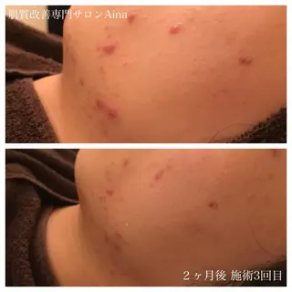 ショート パーマ キッズ ネイル マツエク・マツパ ニキビ跡専門サロン Ainaのエステ・リラクイメージ