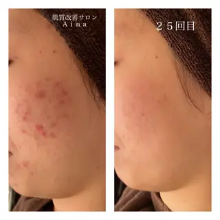 ミディアム カラー パーマ ヘアアレンジ メンズ キッズ ネイル マツエク・マツパ ニキビ跡専門サロン Ａｉｎａのエステ・リラクイメージ