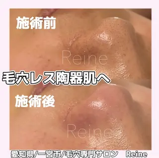 毛穴/シミ肝斑/脱毛 横山梨里のエステ・リラクイメージ