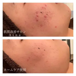 ミディアム カラー パーマ ヘアアレンジ メンズ キッズ ネイル マツエク・マツパ ニキビ跡専門サロン Ａｉｎａのエステ・リラクイメージ