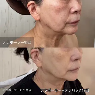 ielu〜毛穴ケア ハーブピーリングのエステ・リラクイメージ