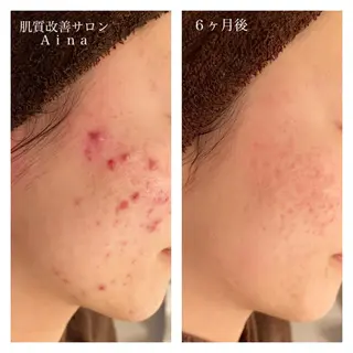ミディアム カラー パーマ ヘアアレンジ メンズ キッズ ネイル マツエク・マツパ ニキビ跡専門サロン Ainaのエステ・リラクイメージ
