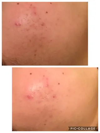 ニキビ/肌質改善専門 Snow skinのエステ・リラクイメージ