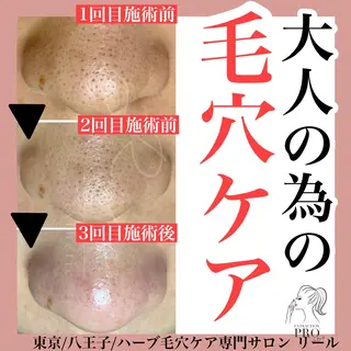 毛穴特化エステ -リールのエステ・リラクイメージ