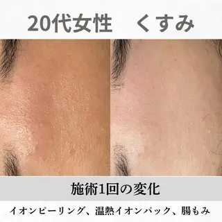重度ニキビ専門🌼 ダウンタイムなしのエステ・リラクイメージ