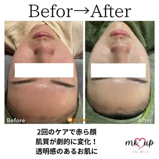 Meupニキビ専門店 背中/ハーブ/肌管理のその他イメージ