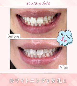 nene -ホワイトニングのその他イメージ