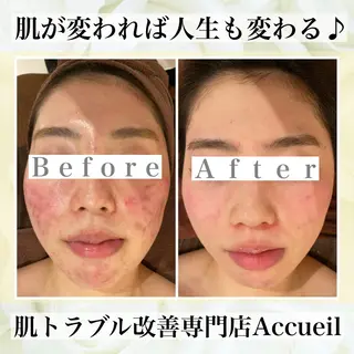 ミディアム カラー パーマ ヘアアレンジ メンズ キッズ ネイル マツエク・マツパ ニキビ・肌質改善専門 ♡人生が変わるサロンのエステ・リラクイメージ