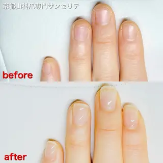 深爪・巻き爪 専門サンセリテのネイルデザイン