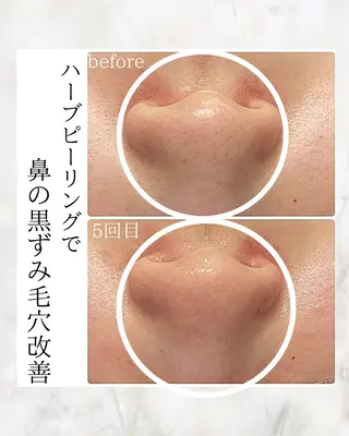 ちひろ　痩身/ハーブ bellissimoのエステ・リラクイメージ