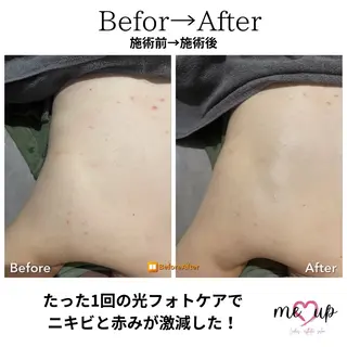 Meupニキビ専門店 背中/ハーブ/肌管理のその他イメージ