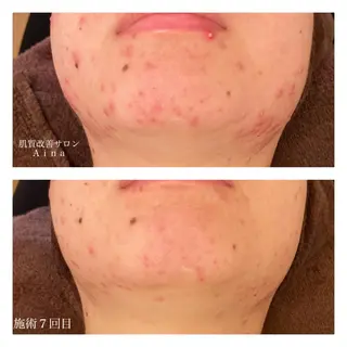 ミディアム カラー パーマ ヘアアレンジ メンズ キッズ ネイル マツエク・マツパ ニキビ跡専門サロン Ainaのエステ・リラクイメージ