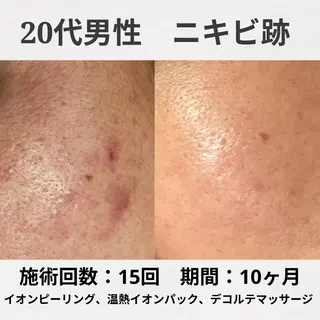 何をしても繰り返す ニキビ・ニキビ跡専門のエステ・リラクイメージ