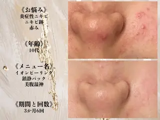 何をしても繰り返す ニキビ・ニキビ跡専門のエステ・リラクイメージ