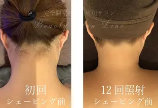 🎀うなじ脱毛🎀 ㅣLino堀江のエステ・リラクイメージ