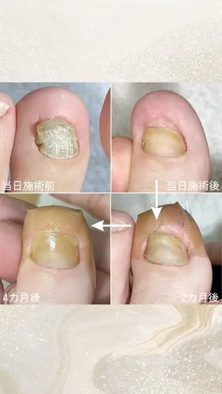 ネイル 巻き爪・肥厚爪ケア 専門サンセリテのネイルデザイン
