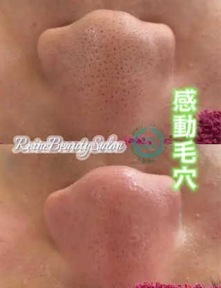 毛穴/シミ肝斑/脱毛 横山梨里のエステ・リラクイメージ