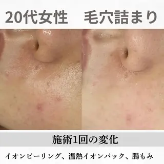 重度ニキビ専門🌼 ダウンタイムなしのエステ・リラクイメージ