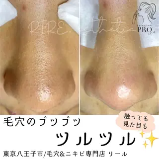 毛穴特化エステ -リールのエステ・リラクイメージ