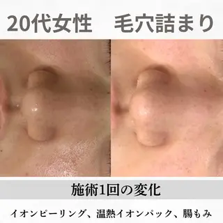 重度ニキビ専門🌷 ダウンタイムなしのエステ・リラクイメージ