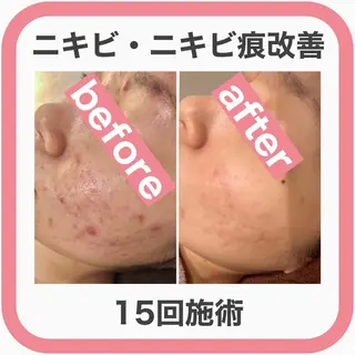 ミディアム カラー パーマ ヘアアレンジ メンズ キッズ ネイル マツエク・マツパ ニキビ・肌質改善専門 ♡人生が変わるサロンのエステ・リラクイメージ