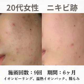 重度ニキビ専門🌼 ダウンタイムなしのエステ・リラクイメージ