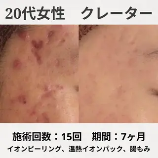 何をしても繰り返す ニキビ・ニキビ跡専門のエステ・リラクイメージ
