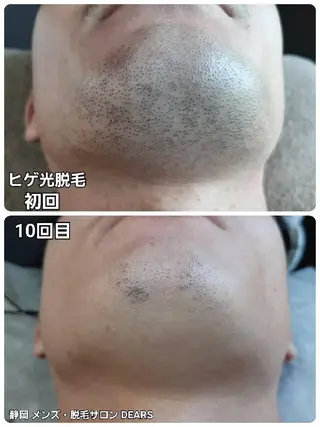 メンズ 山村幸久 メンズ脱毛 ディアーズのエステ・リラクイメージ