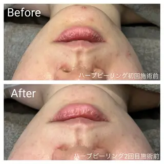 深い肌悩み&早期脱毛 完了サロンのエステ・リラクイメージ