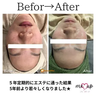 Meupニキビ専門店 背中/ハーブ/肌管理のその他イメージ
