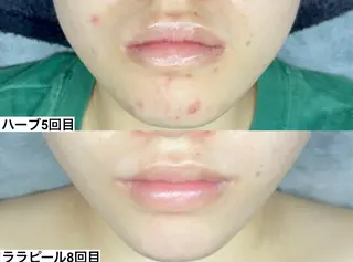 ピーリング×肌質管理 &meのエステ・リラクイメージ