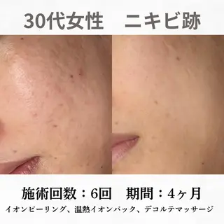重度ニキビ専門🌷 ダウンタイムなしのエステ・リラクイメージ