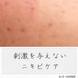 ニキビ経験者が施術 する専門サロン🌻のエステ・リラクイメージ
