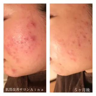 セミロング カラー パーマ ヘアアレンジ メンズ キッズ ネイル マツエク・マツパ ニキビ跡専門サロン Ainaのエステ・リラクイメージ