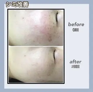 🌷MURA 毛穴・顔脱毛🌷のエステ・リラクイメージ