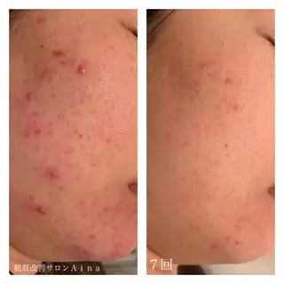 セミロング カラー パーマ ヘアアレンジ メンズ キッズ ネイル マツエク・マツパ ニキビ跡専門サロン Ainaのエステ・リラクイメージ