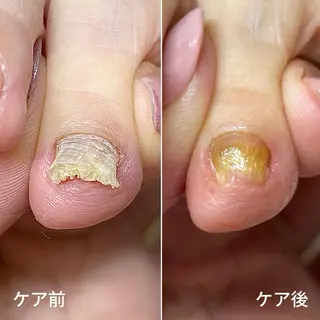 ネイル 巻き爪・肥厚爪ケア 専門サンセリテのネイルデザイン