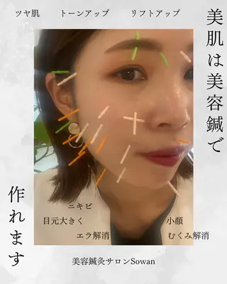 肌質改善美容鍼 ×ハーブピーリングのエステ・リラクイメージ