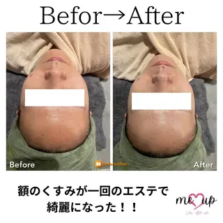 Meupニキビ専門店 背中/ハーブ/肌管理のその他イメージ