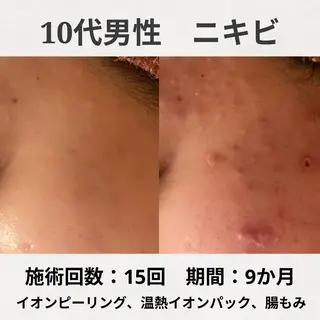 ニキビ特化型エステ 🍋最短で肌質改善のエステ・リラクイメージ