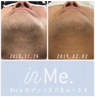 メンズ ◆つど払い脱毛◆ in Me.インミーのエステ・リラクイメージ