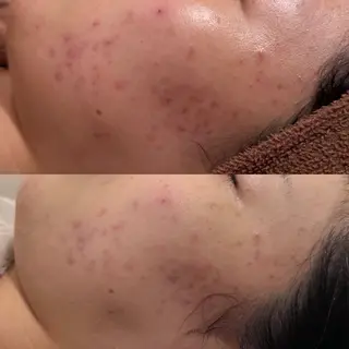 ニキビ特化型エステ 🍋最短で肌質改善のエステ・リラクイメージ