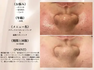 何をしても繰り返す ニキビ・ニキビ跡専門のエステ・リラクイメージ