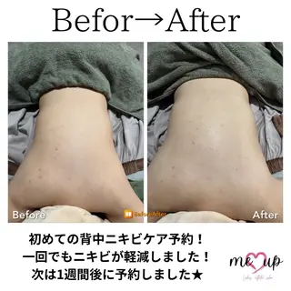 Meupニキビ専門店 背中/ハーブ/肌管理のその他イメージ