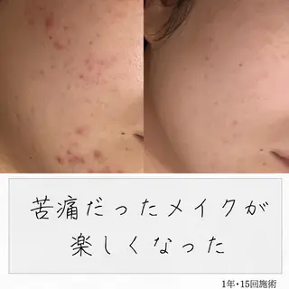 ニキビ経験者が施術 する専門サロン🌻のエステ・リラクイメージ