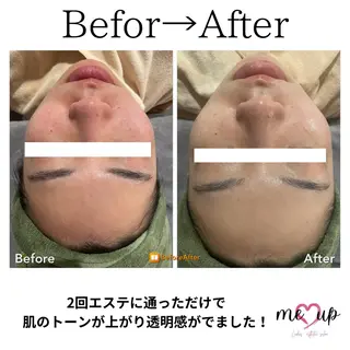 Meupニキビ専門店 背中/ハーブ/肌管理のその他イメージ