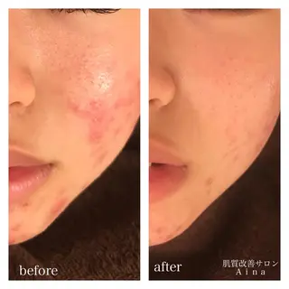 ショート カラー パーマ ヘアアレンジ メンズ キッズ ネイル マツエク・マツパ ニキビ跡専門サロン Ainaのエステ・リラクイメージ