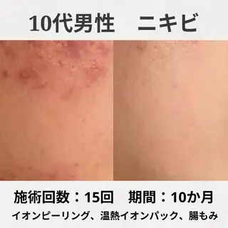 繰り返すニキビ跡専門 根本改善のエステ・リラクイメージ